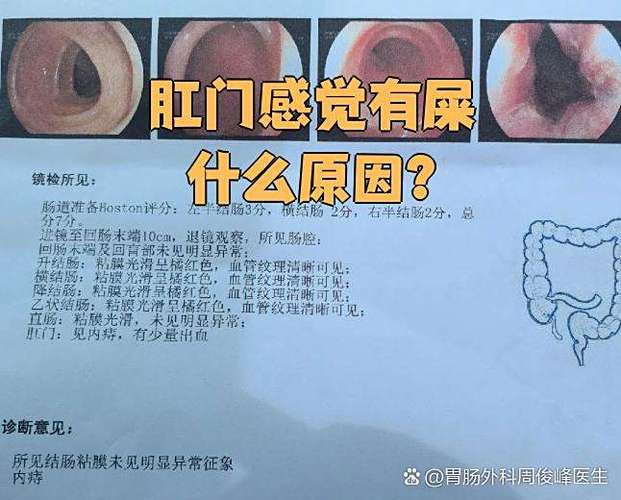 老人肛门漏粪是什么病