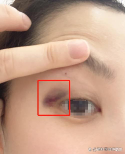 眼睛於紫怎么好得快