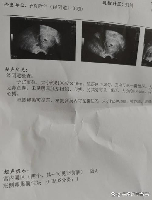 孕6周只看到一个暗区