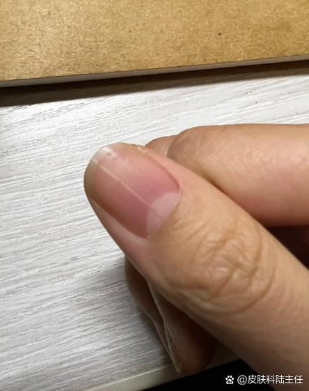 手指上有条疤痕状白线