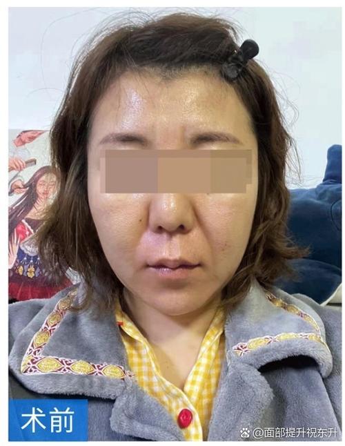 脸垮了还能养回来吗