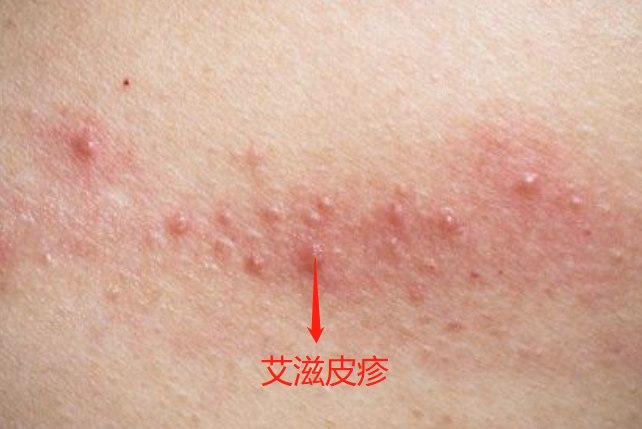 红色斑丘疹