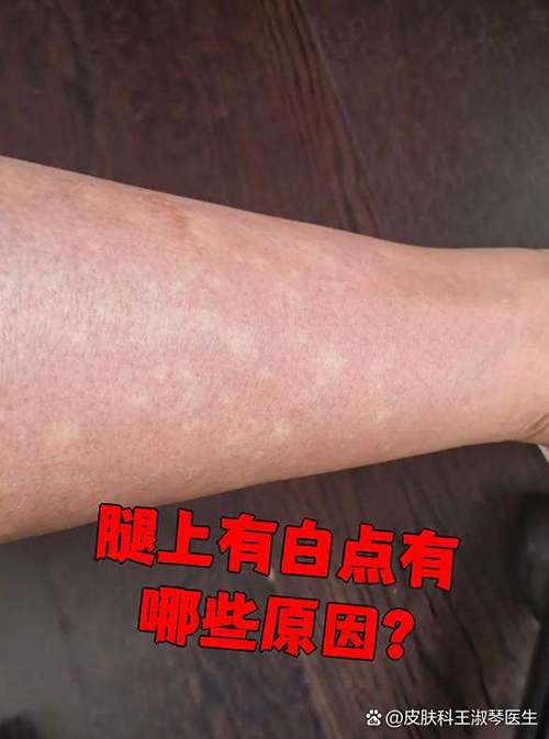 皮肤上的小白点儿是怎么回事儿