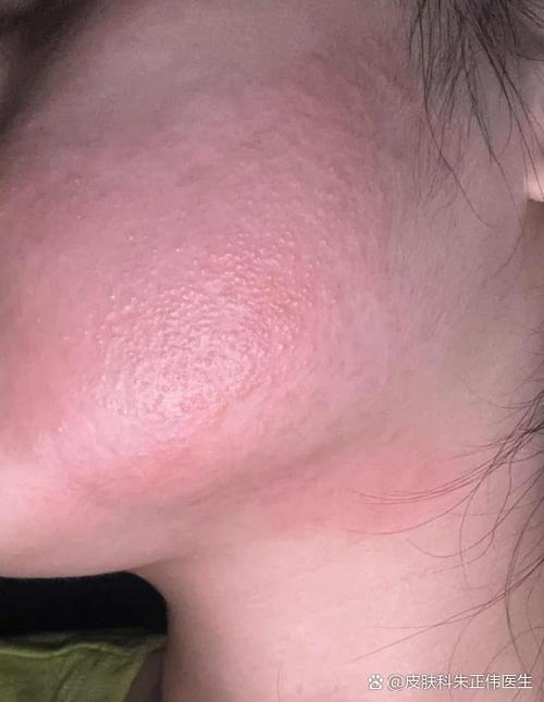 脖子上红疹千万要当心