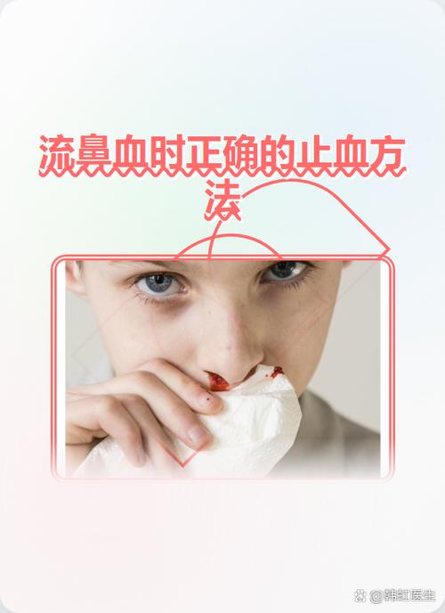 间歇性流鼻血