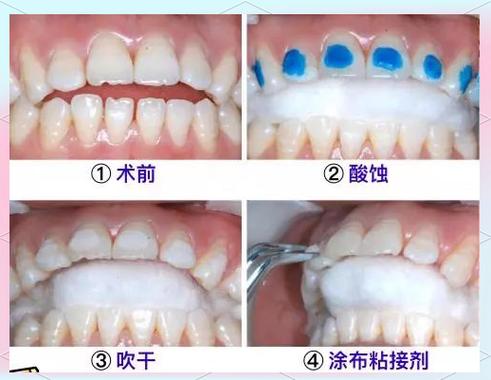 恒牙松了还会牢固吗