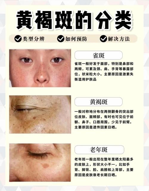 雀斑最怕的克星