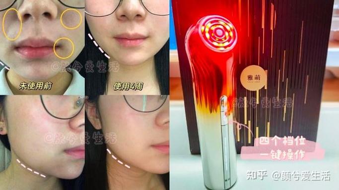 雅萌黄金五环射频仪