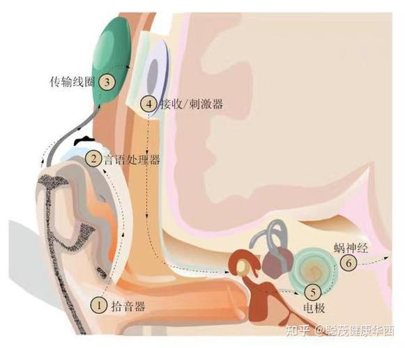 人工耳蜗的原理