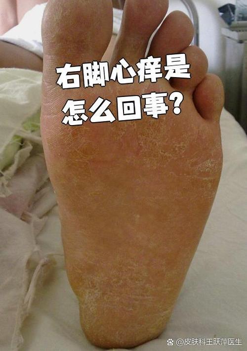 晚上睡觉脚心痒是什么原因