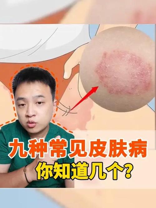 皮肤病的种类图片大全