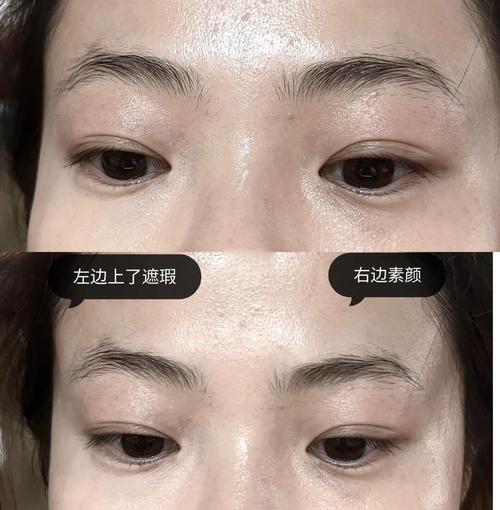 弗曼填充泪沟多久见效