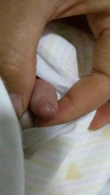 小鸡肿了是怎么回事