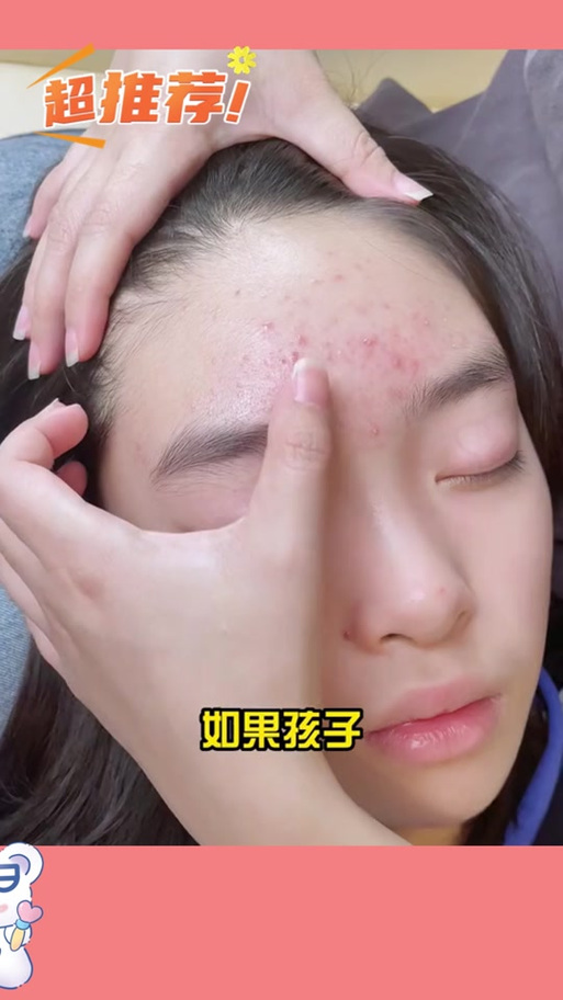 痘痘黑印怎么去除