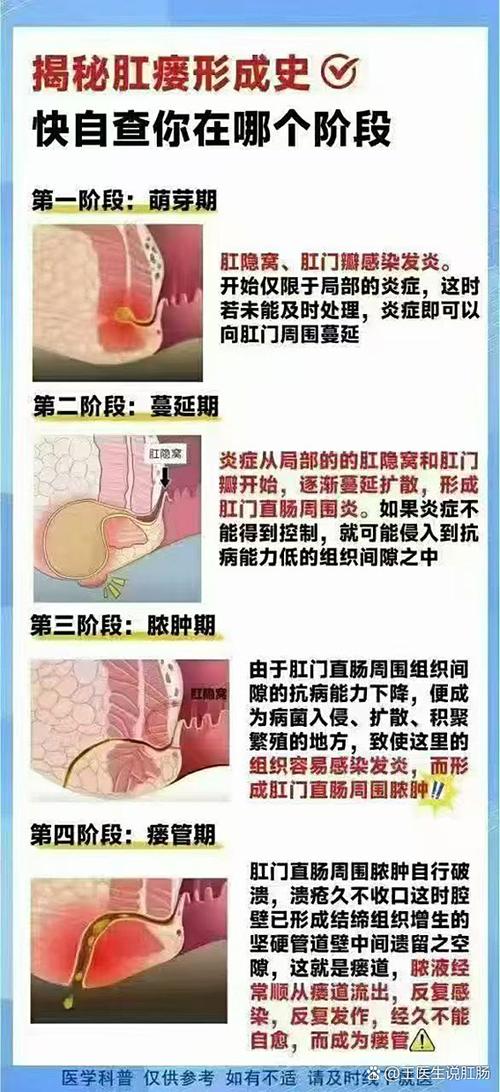 肛门漏粪便是什么病