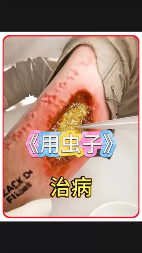 伤口长蛆